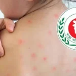 দেশে হাম ও এর উপসর্গে মৃত্যু বেড়ে ১০৩০, নতুন আক্রান্ত ১২৩২ জন