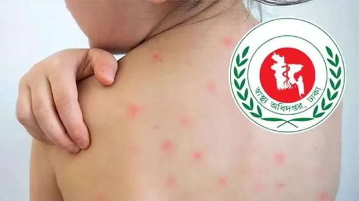 দেশে হাম ও এর উপসর্গে মৃত্যু বেড়ে ১০৩০, নতুন আক্রান্ত ১২৩২ জন